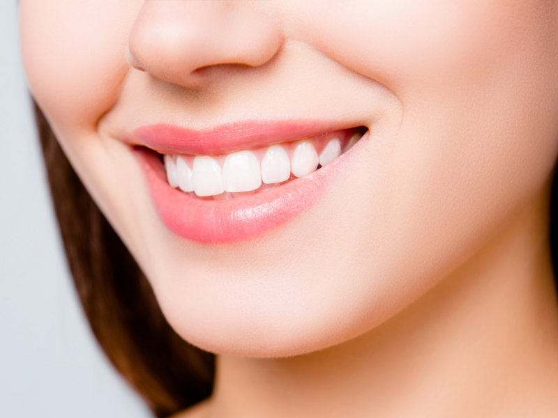 Teeth Whitening
